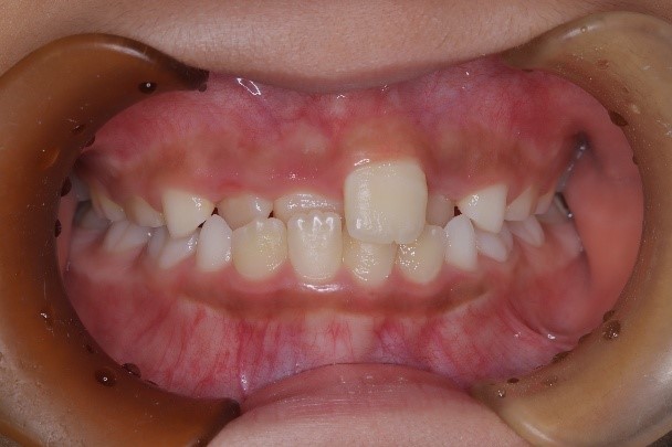 前歯部反対咬合、叢生(1期治療)