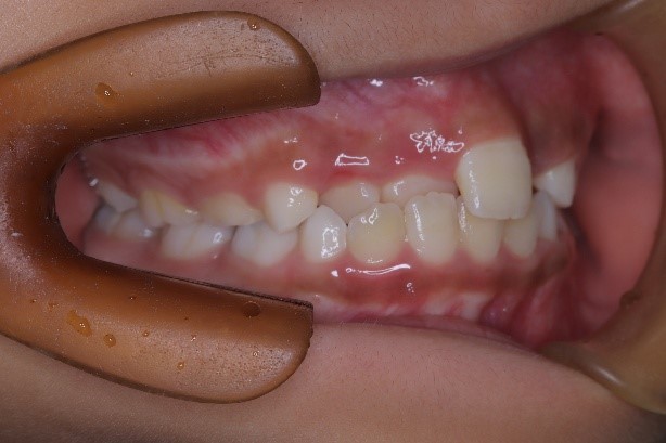 前歯部反対咬合、叢生(1期治療)