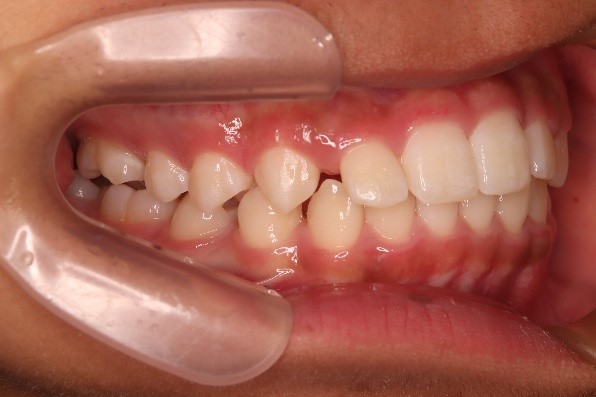 前歯部反対咬合、叢生(1期治療)