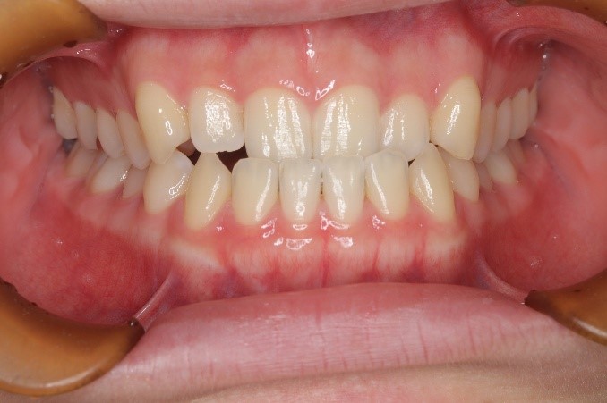 前歯部反対咬合