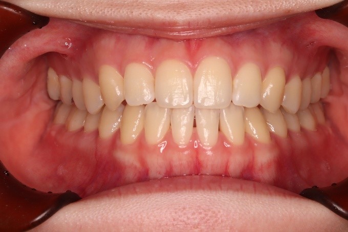 前歯部反対咬合