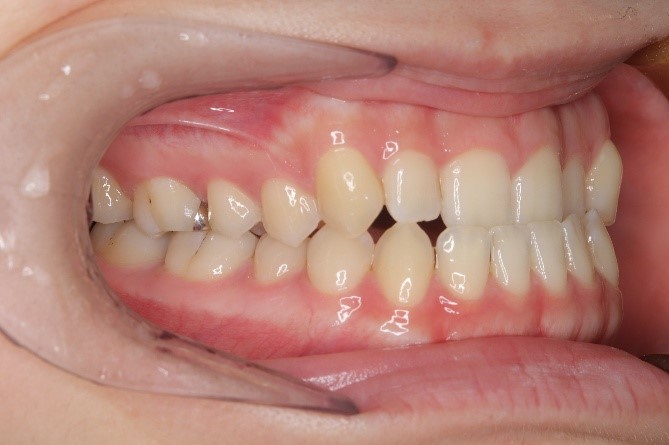 前歯部反対咬合