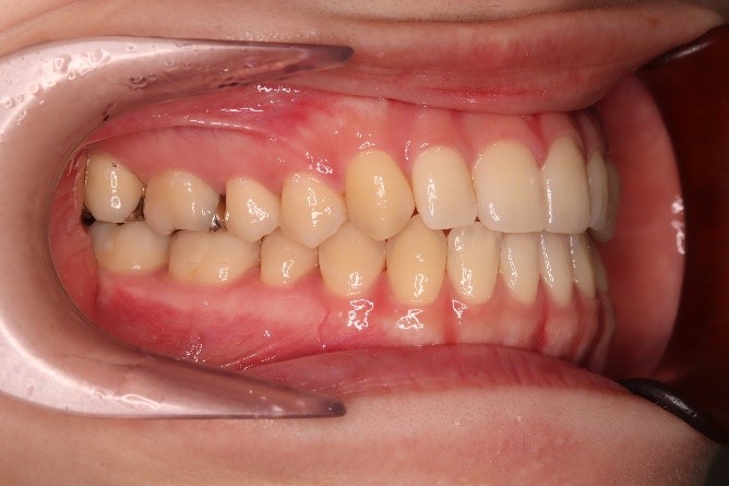 前歯部反対咬合