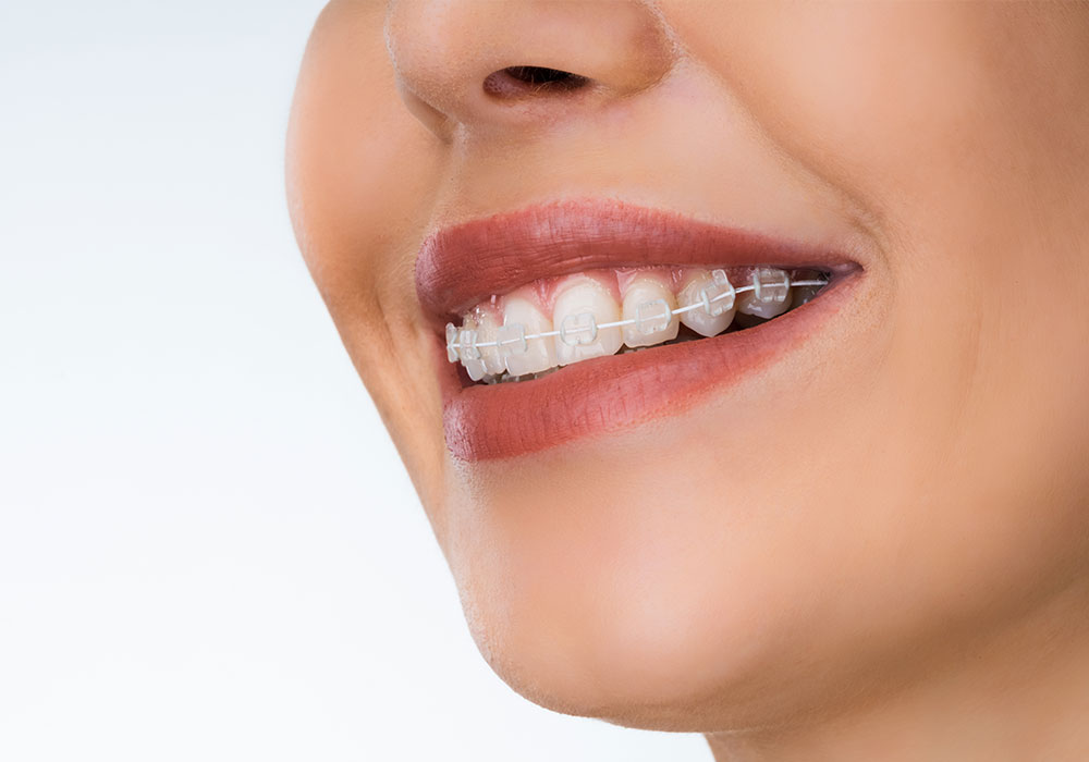 矯正治療を始めませんか?