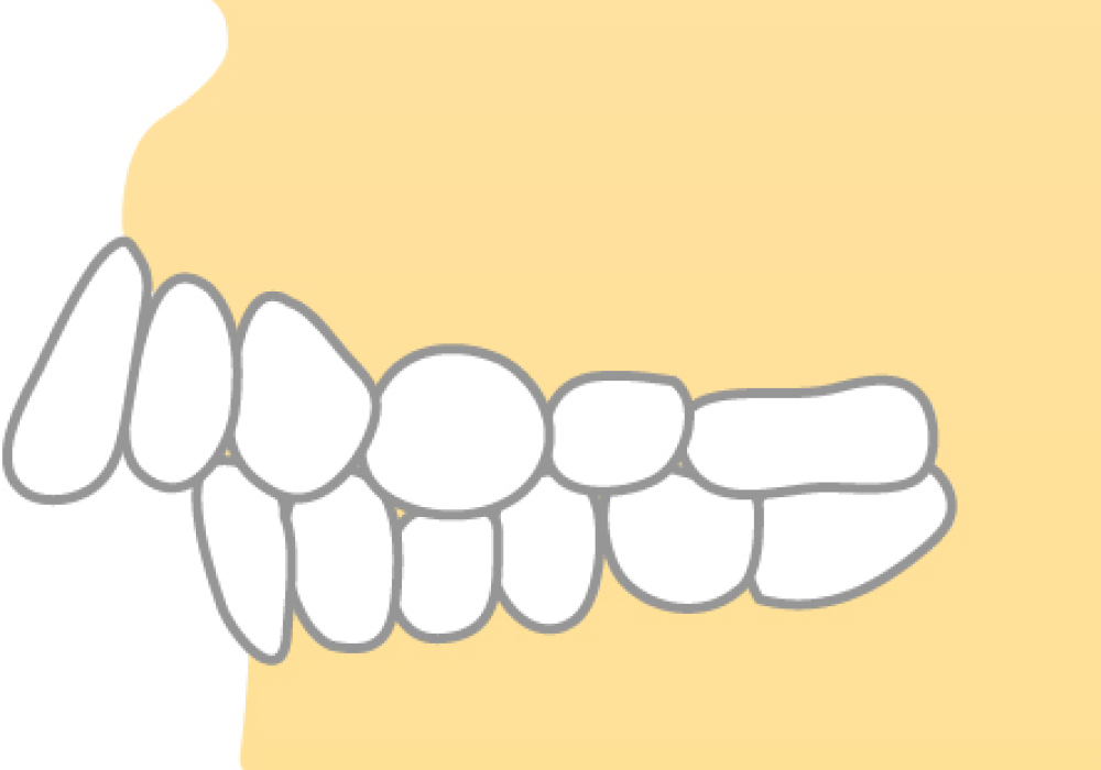 上顎前突(じょうがくぜんとつ)
