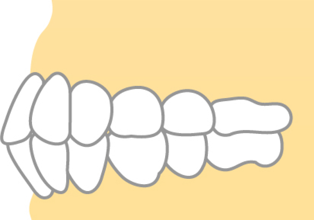 上下顎前突(じょうげがくぜんとつ)