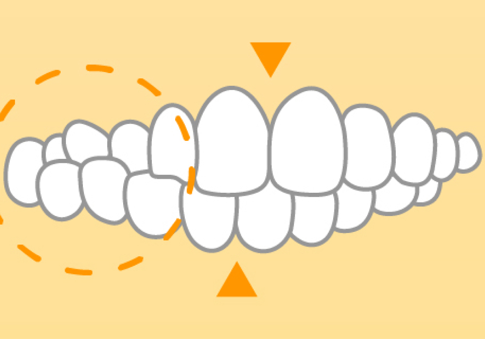 交叉咬合(こうさこうごう)
