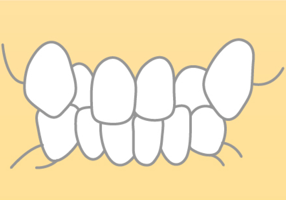 叢生(そうせい)