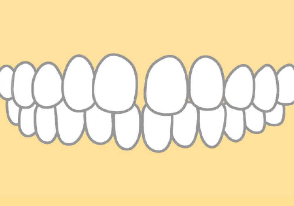 空隙歯列(くうげきしれつ)