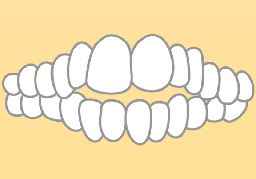 開咬(かいこう)