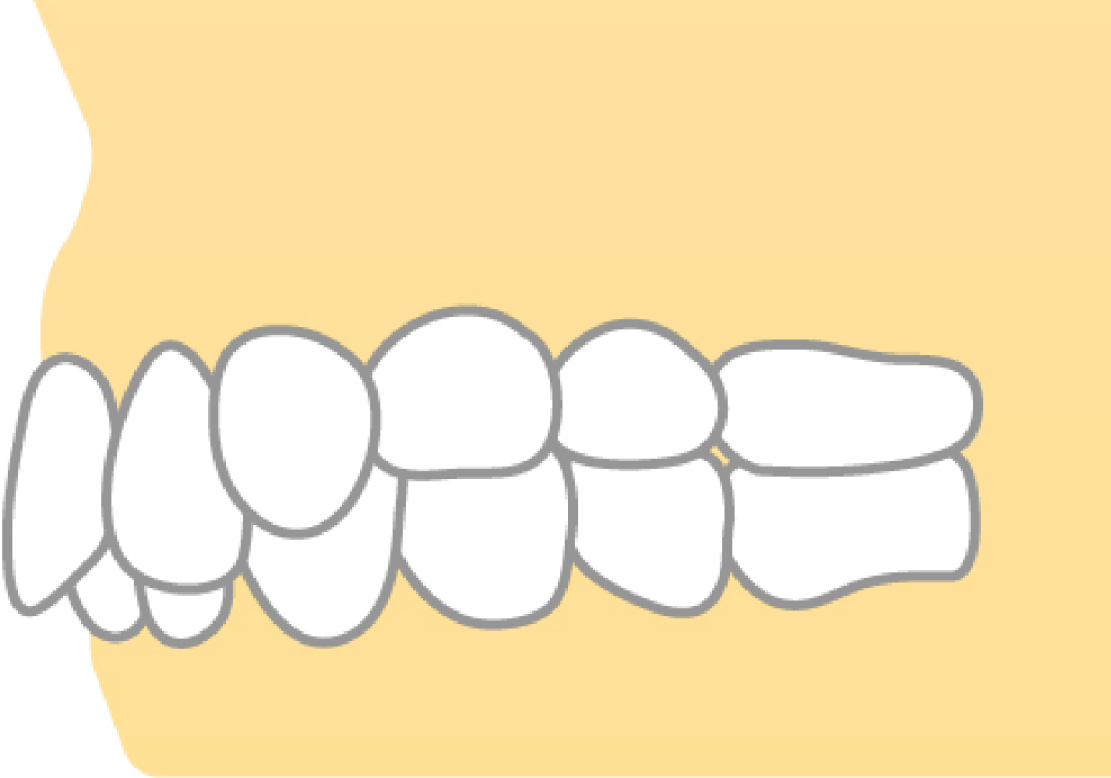 過蓋咬合(かがいこうごう)