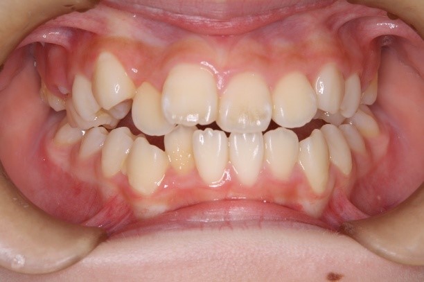 犬歯低位唇側転位を伴う開咬、上顎前突および叢生(10歳)