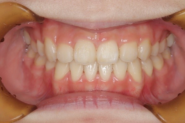 犬歯低位唇側転位を伴う開咬、上顎前突および叢生(10歳)