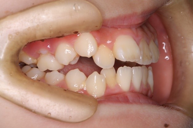 犬歯低位唇側転位を伴う開咬、上顎前突および叢生(10歳)